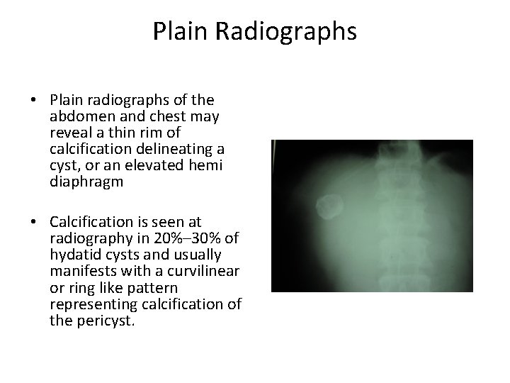 Plain Radiographs • Plain radiographs of the abdomen and chest may reveal a thin Plain Radiographs • Plain radiographs of the abdomen and chest may reveal a thin