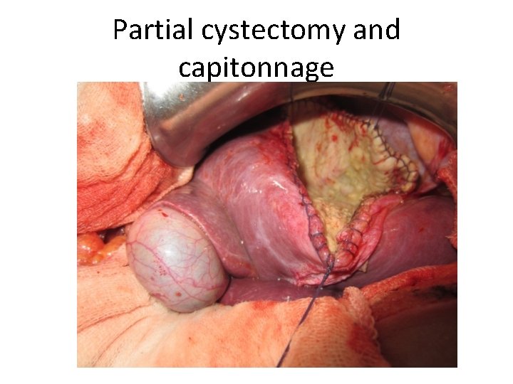 Partial cystectomy and capitonnage Partial cystectomy and capitonnage