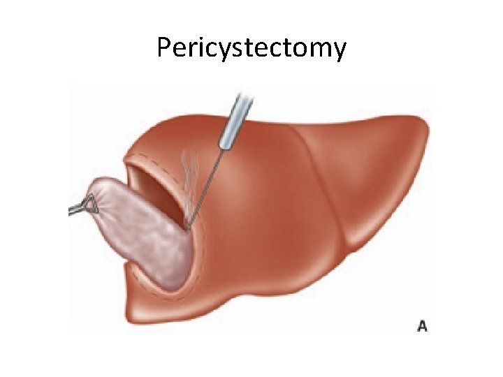 Pericystectomy Pericystectomy
