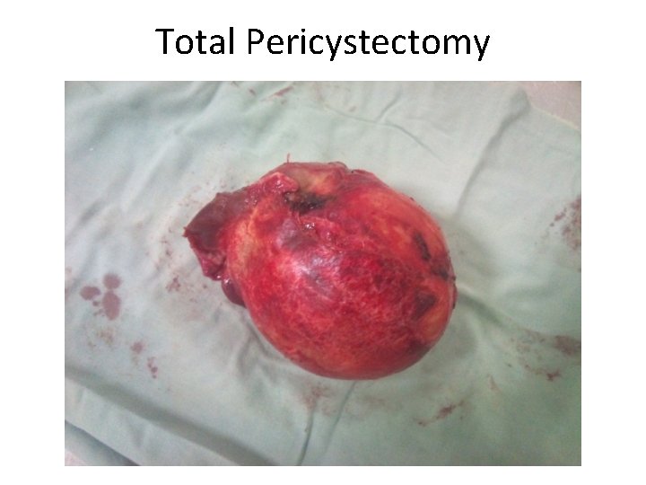 Total Pericystectomy Total Pericystectomy