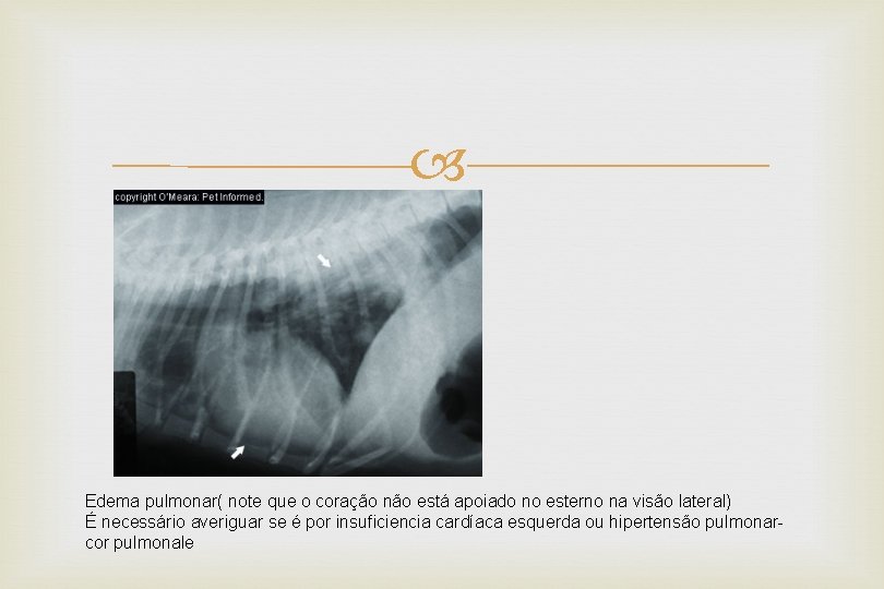  Edema pulmonar( note que o coração não está apoiado no esterno na visão