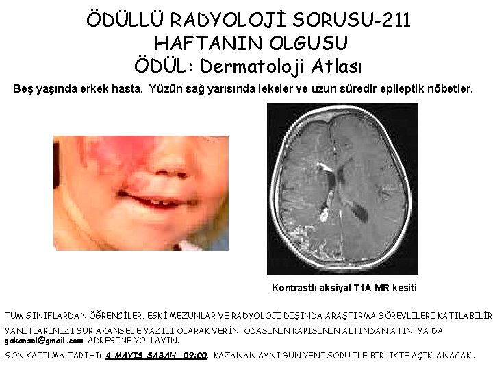 ÖDÜLLÜ RADYOLOJİ SORUSU-211 HAFTANIN OLGUSU ÖDÜL: Dermatoloji Atlası Beş yaşında erkek hasta. Yüzün sağ