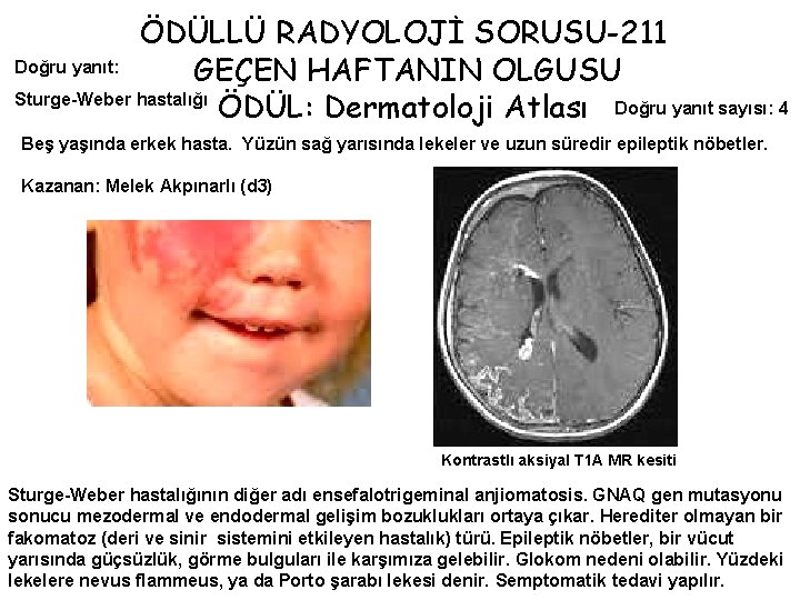 ÖDÜLLÜ RADYOLOJİ SORUSU-211 Doğru yanıt: GEÇEN HAFTANIN OLGUSU Sturge-Weber hastalığı ÖDÜL: Dermatoloji Atlası Doğru
