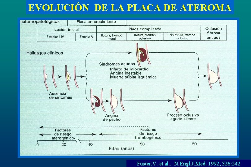 EVOLUCIÓN DE LA PLACA DE ATEROMA Fuster, V. et al. . N. Engl. J.