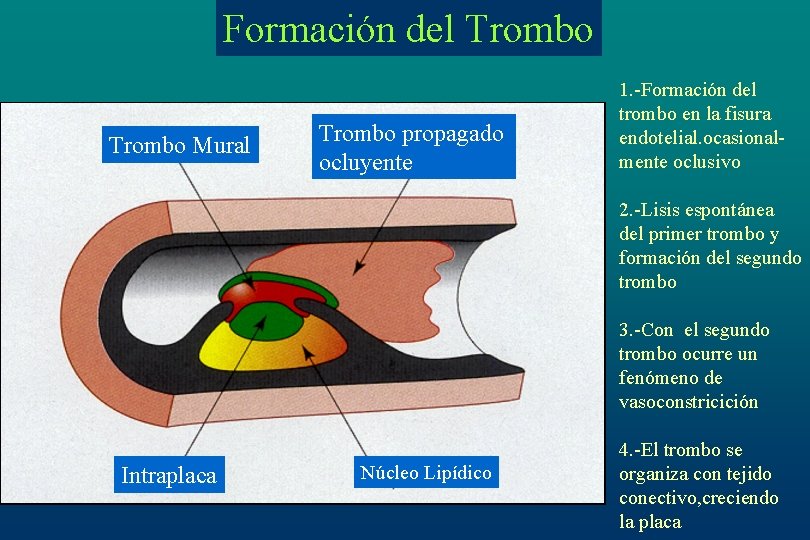 Formación del Trombo Mural Trombo propagado ocluyente 1. -Formación del trombo en la fisura