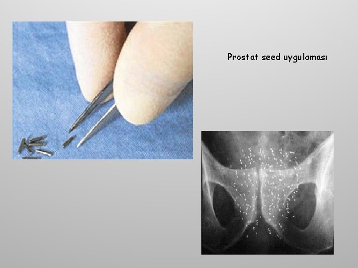 Prostat seed uygulaması 