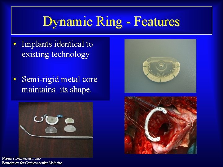 Dynamic Ring - Features • Implants identical to existing technology • Semi-rigid metal core