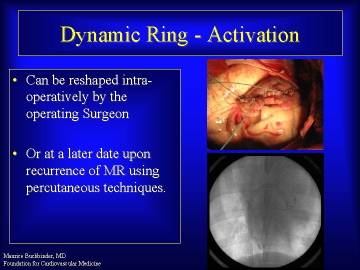 Dynamic Ring - Activation • Can be reshaped intraoperatively by the operating Surgeon •