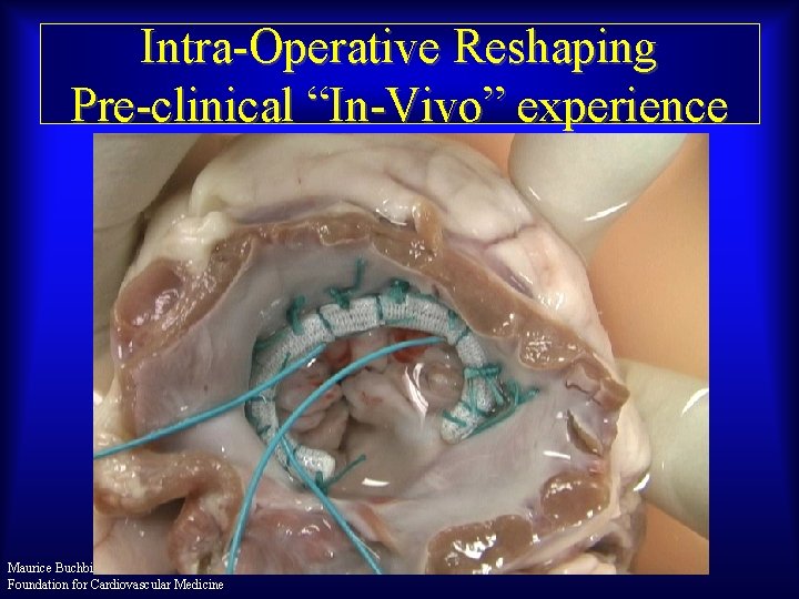 Intra-Operative Reshaping Pre-clinical “In-Vivo” experience Maurice Buchbinder, MD Foundation for Cardiovascular Medicine 