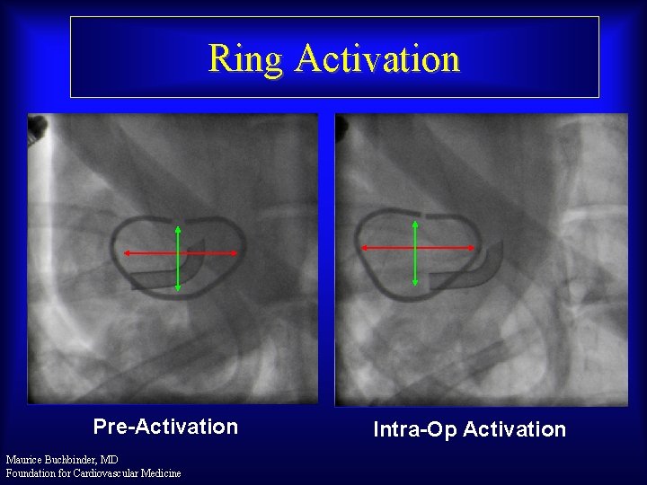 Ring Activation Pre-Activation Maurice Buchbinder, MD Foundation for Cardiovascular Medicine Intra-Op Activation 