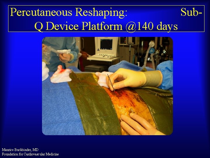 Percutaneous Reshaping: Sub. Q Device Platform @140 days Maurice Buchbinder, MD Foundation for Cardiovascular
