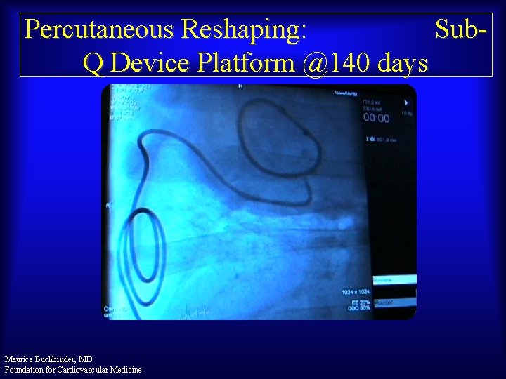 Percutaneous Reshaping: Sub. Q Device Platform @140 days Maurice Buchbinder, MD Foundation for Cardiovascular