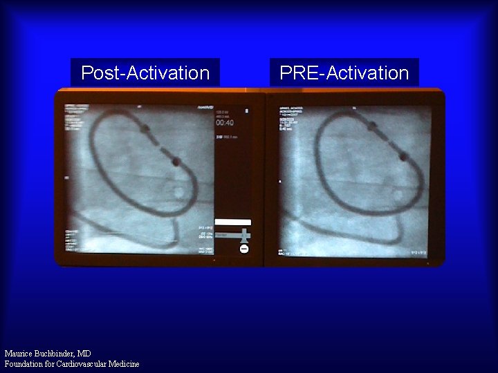 Post-Activation Maurice Buchbinder, MD Foundation for Cardiovascular Medicine PRE-Activation 