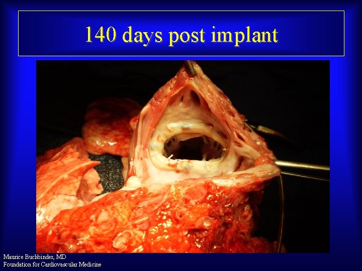 140 days post implant Maurice Buchbinder, MD Foundation for Cardiovascular Medicine 