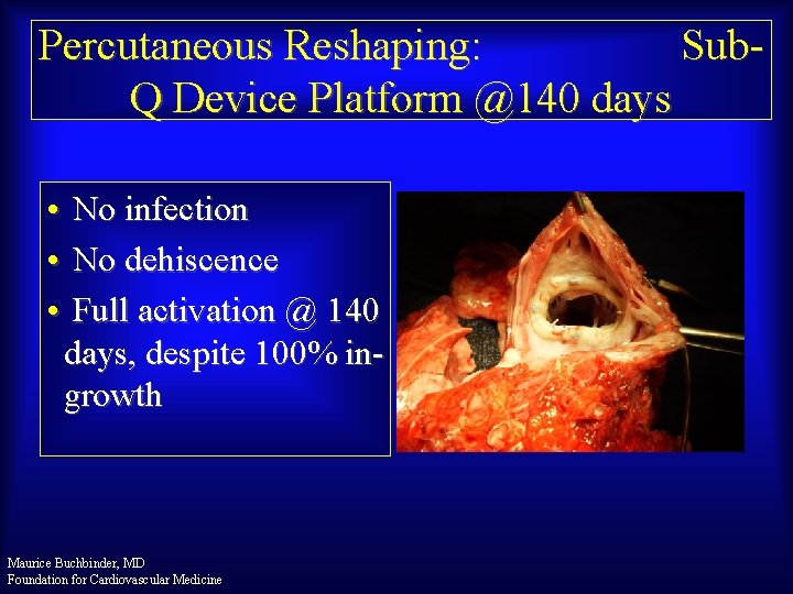 Percutaneous Reshaping: Sub. Q Device Platform @140 days • No infection • No dehiscence