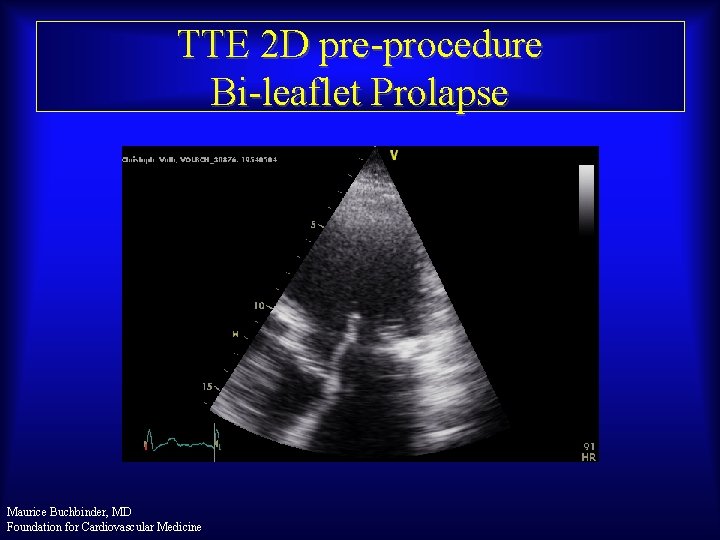 TTE 2 D pre-procedure Bi-leaflet Prolapse Maurice Buchbinder, MD Foundation for Cardiovascular Medicine 