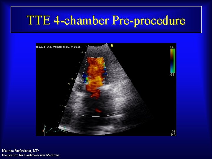 TTE 4 -chamber Pre-procedure Maurice Buchbinder, MD Foundation for Cardiovascular Medicine 