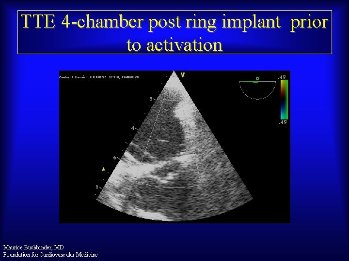 TTE 4 -chamber post ring implant prior to activation Maurice Buchbinder, MD Foundation for