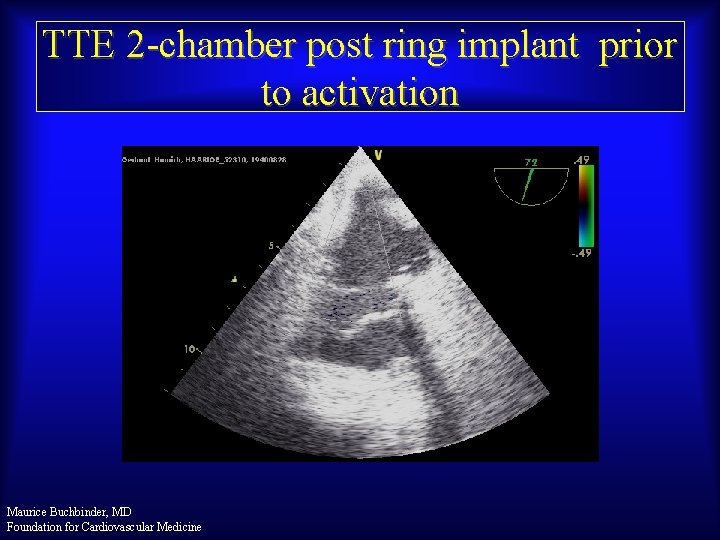 TTE 2 -chamber post ring implant prior to activation Maurice Buchbinder, MD Foundation for