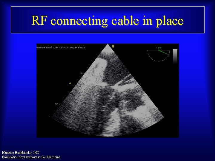 RF connecting cable in place Maurice Buchbinder, MD Foundation for Cardiovascular Medicine 