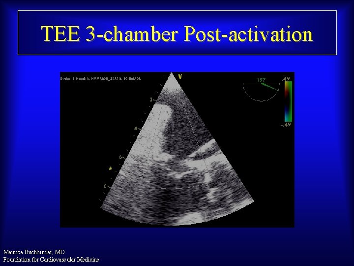 TEE 3 -chamber Post-activation Maurice Buchbinder, MD Foundation for Cardiovascular Medicine 