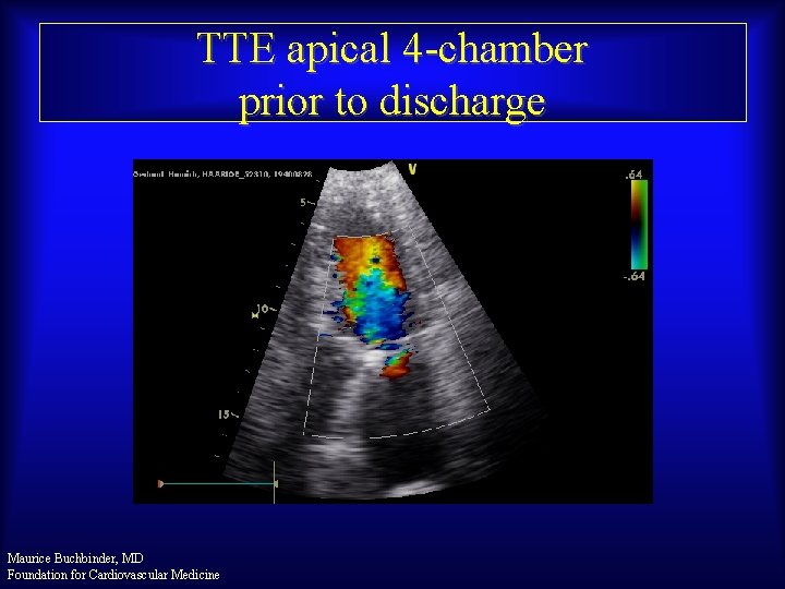 TTE apical 4 -chamber prior to discharge Maurice Buchbinder, MD Foundation for Cardiovascular Medicine