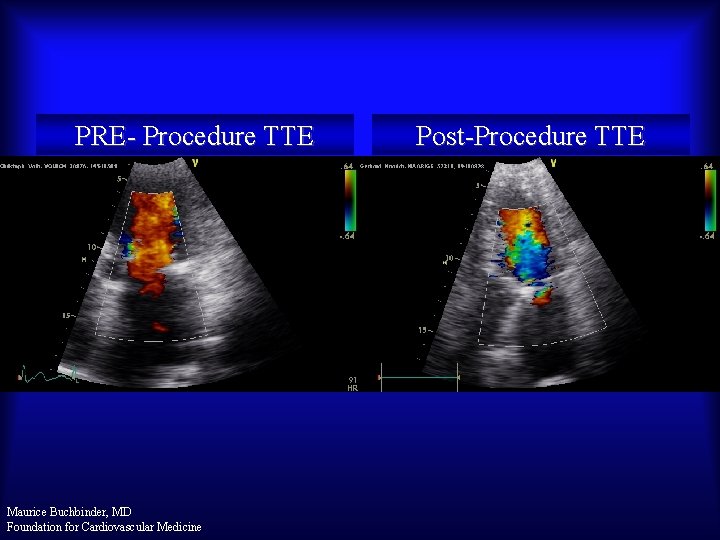 PRE- Procedure TTE Maurice Buchbinder, MD Foundation for Cardiovascular Medicine Post-Procedure TTE 