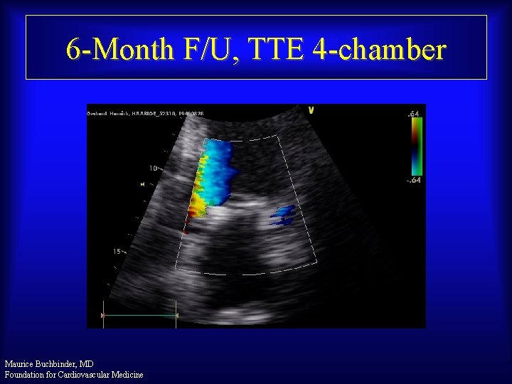 6 -Month F/U, TTE 4 -chamber Maurice Buchbinder, MD Foundation for Cardiovascular Medicine 