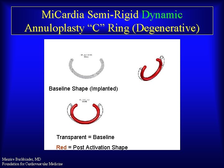 Mi. Cardia Semi-Rigid Dynamic Annuloplasty “C” Ring (Degenerative) Baseline Shape (Implanted) Transparent = Baseline