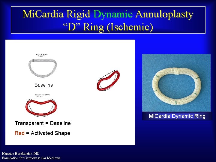 Mi. Cardia Rigid Dynamic Annuloplasty “D” Ring (Ischemic) Baseline Mi. Cardia Dynamic Ring Transparent