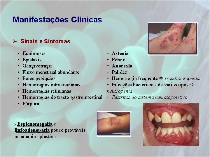 Manifestações Clínicas Ø Sinais e Sintomas • • • Equimoses Epistáxis Gengivorragia Fluxo menstrual Manifestações Clínicas Ø Sinais e Sintomas • • • Equimoses Epistáxis Gengivorragia Fluxo menstrual