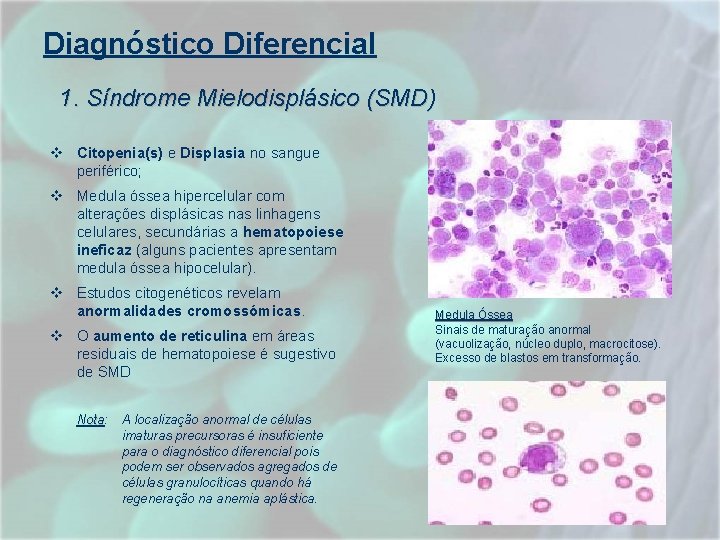 Diagnóstico Diferencial 1. Síndrome Mielodisplásico (SMD) v Citopenia(s) e Displasia no sangue periférico; v Diagnóstico Diferencial 1. Síndrome Mielodisplásico (SMD) v Citopenia(s) e Displasia no sangue periférico; v