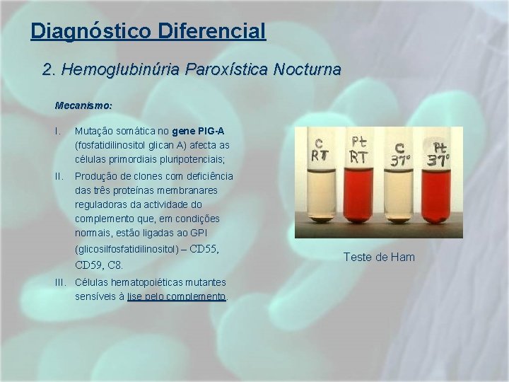 Diagnóstico Diferencial 2. Hemoglubinúria Paroxística Nocturna Mecanismo: I. Mutação somática no gene PIG-A (fosfatidilinositol Diagnóstico Diferencial 2. Hemoglubinúria Paroxística Nocturna Mecanismo: I. Mutação somática no gene PIG-A (fosfatidilinositol