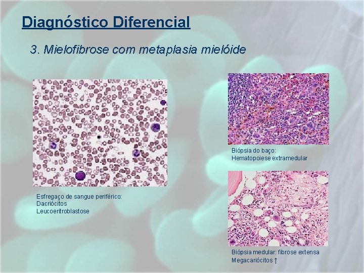 Diagnóstico Diferencial 3. Mielofibrose com metaplasia mielóide Biópsia do baço: Hematopoiese extramedular Esfregaço de Diagnóstico Diferencial 3. Mielofibrose com metaplasia mielóide Biópsia do baço: Hematopoiese extramedular Esfregaço de