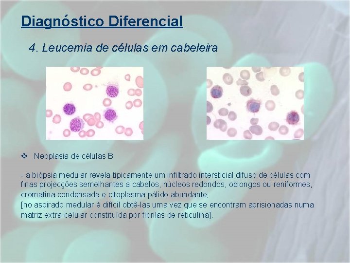 Diagnóstico Diferencial 4. Leucemia de células em cabeleira v Neoplasia de células B - Diagnóstico Diferencial 4. Leucemia de células em cabeleira v Neoplasia de células B -