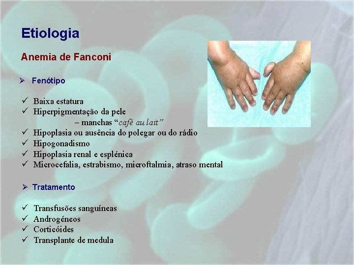 Etiologia Anemia de Fanconi Ø Fenótipo Baixa estatura Hiperpigmentação da pele – manchas “café Etiologia Anemia de Fanconi Ø Fenótipo Baixa estatura Hiperpigmentação da pele – manchas “café
