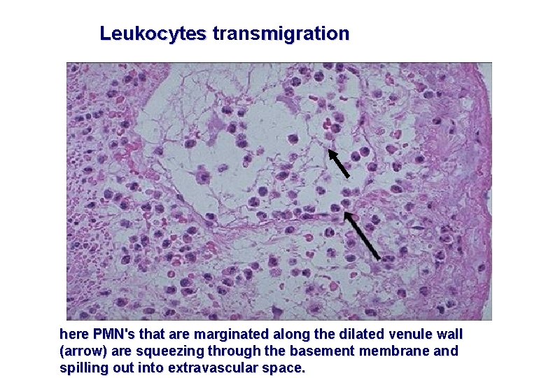 Leukocytes transmigration here PMN's that are marginated along the dilated venule wall (arrow) are