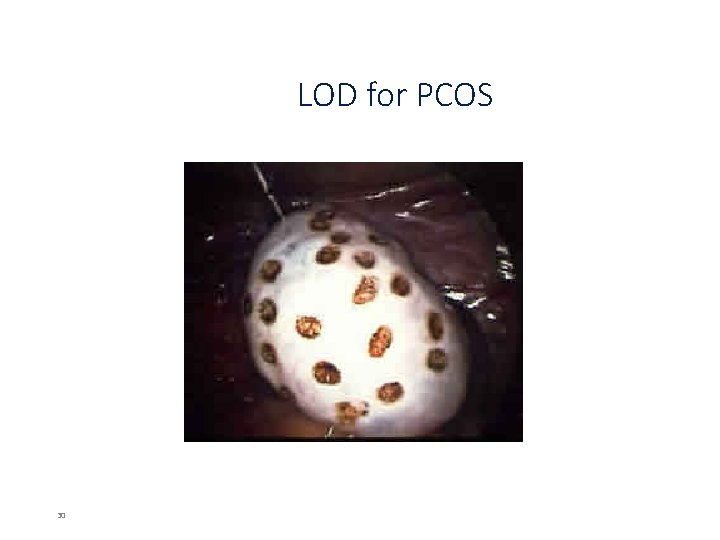 LOD for PCOS 30 