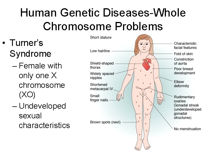 Human Genetic Diseases-Whole Chromosome Problems • Turner’s Syndrome – Female with only one X