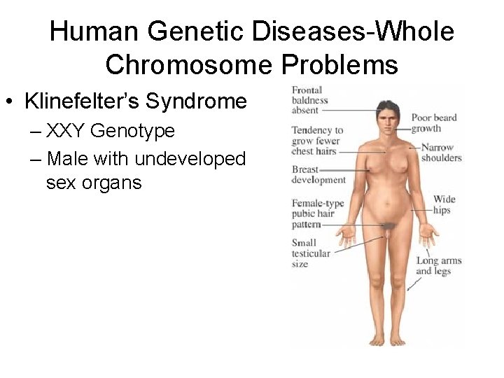 Human Genetic Diseases-Whole Chromosome Problems • Klinefelter’s Syndrome – XXY Genotype – Male with