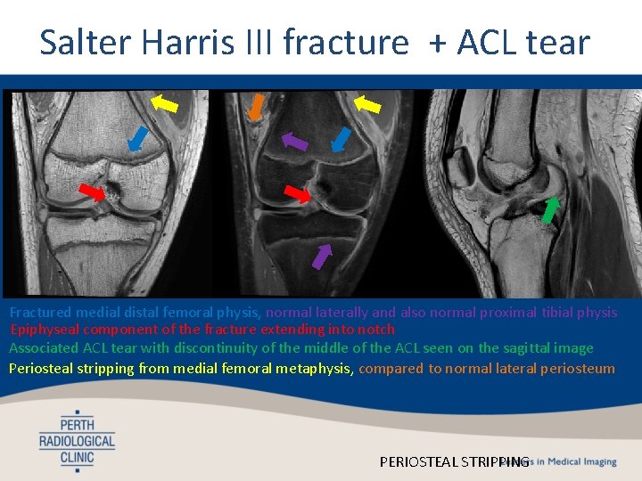 Salter Harris III fracture + ACL tear Fractured medial distal femoral physis, normal laterally Salter Harris III fracture + ACL tear Fractured medial distal femoral physis, normal laterally