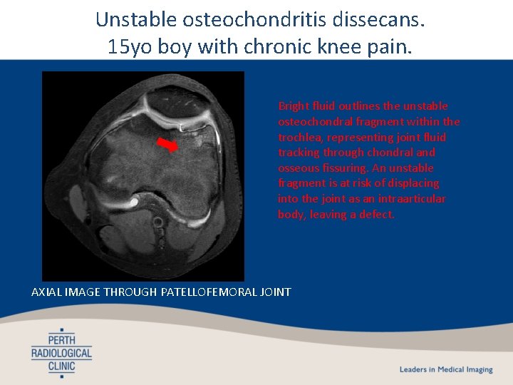 Unstable osteochondritis dissecans. 15 yo boy with chronic knee pain. Bright fluid outlines the Unstable osteochondritis dissecans. 15 yo boy with chronic knee pain. Bright fluid outlines the