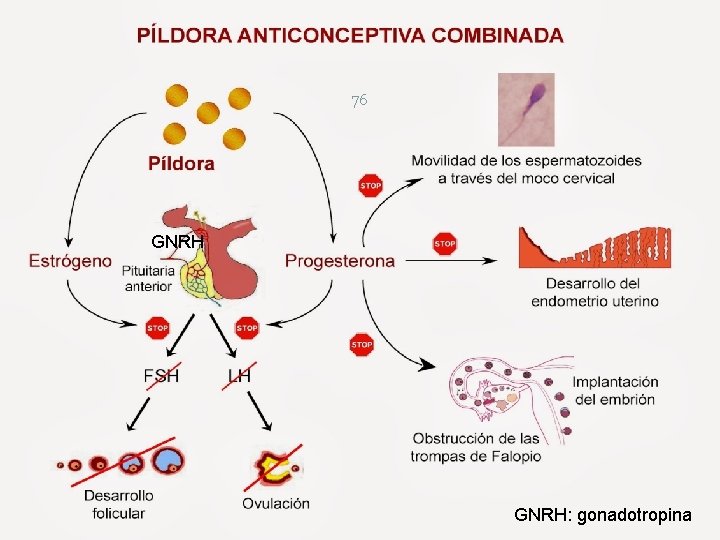 76 GNRH: gonadotropina 