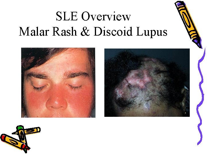 SLE Overview Malar Rash & Discoid Lupus 