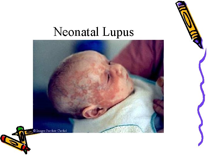 Neonatal Lupus 