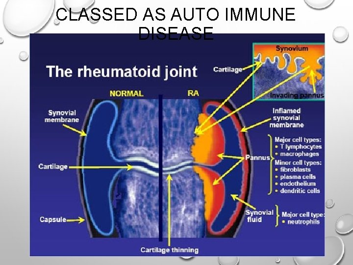 CLASSED AS AUTO IMMUNE DISEASE 