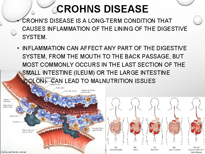 CROHNS DISEASE • CROHN'S DISEASE IS A LONG-TERM CONDITION THAT CAUSES INFLAMMATION OF THE