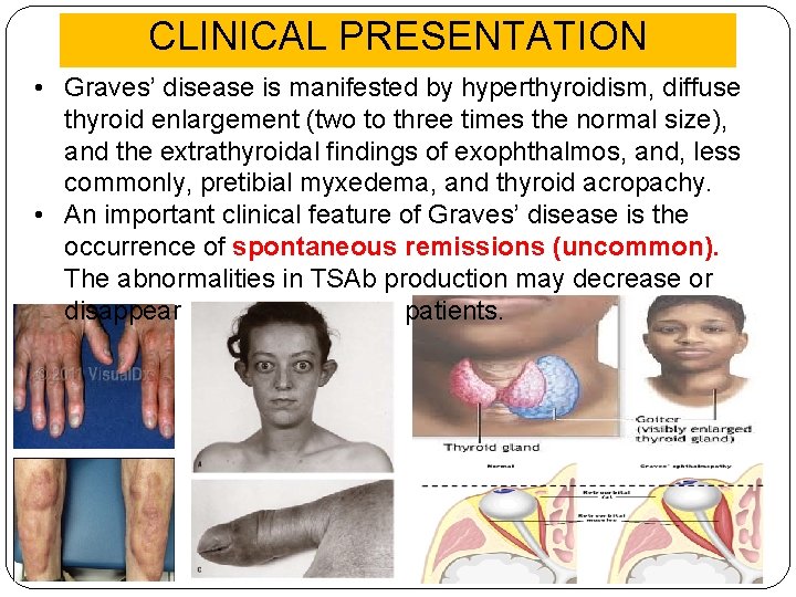 CLINICAL PRESENTATION • Graves’ disease is manifested by hyperthyroidism, diffuse thyroid enlargement (two to