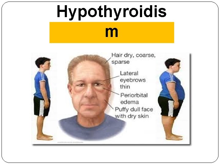 Hypothyroidis m 