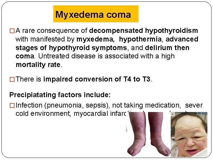 Myxedema coma � A rare consequence of decompensated hypothyroidism with manifested by myxedema, hypothermia,